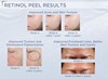 DUNG DỊCH PEEL DA NEOSTRATA RETINOL PEEL